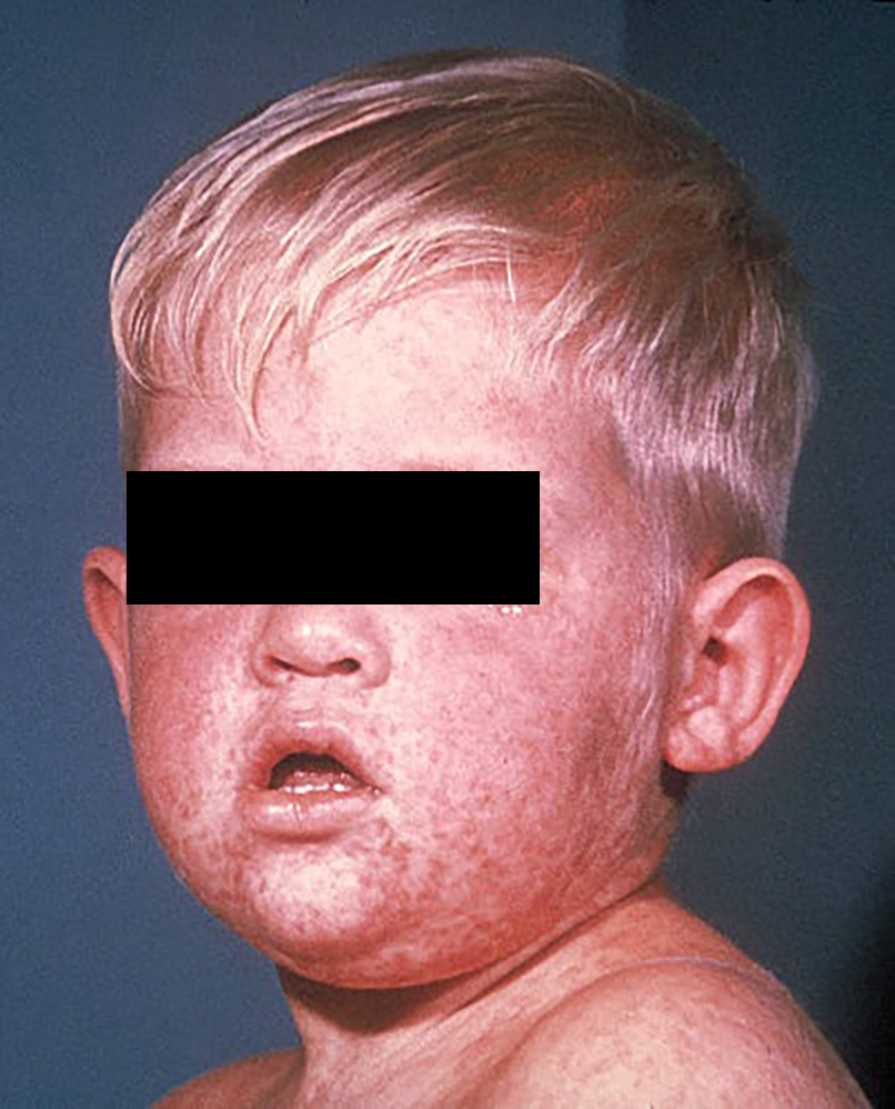 Аллергический кашель у детей — как отличить от обычного и чем лечить